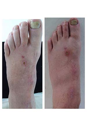 diabetic foot infection